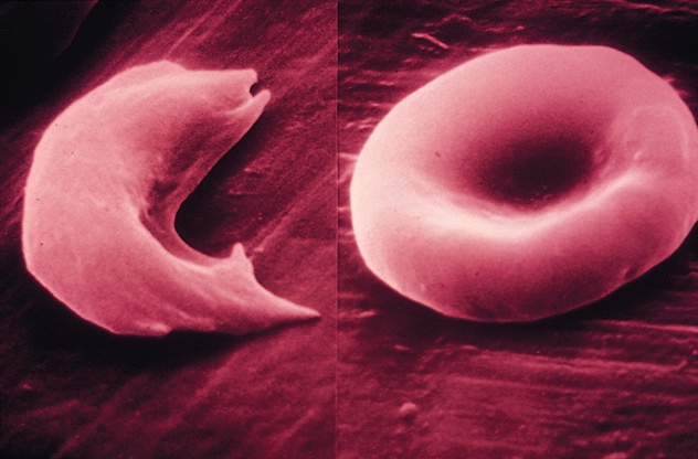 sickle-cell-hemoglobin